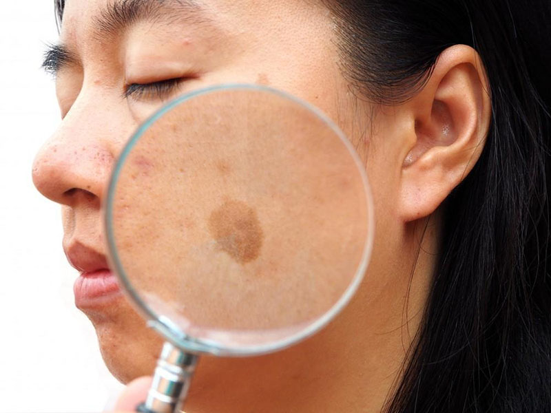 Picosecond Laser: Một người trợ giúp tốt để loại bỏ NENASMA