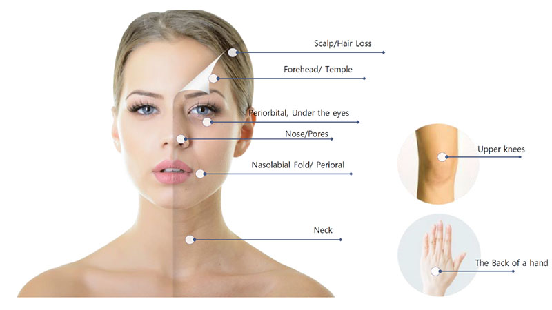 Tại sao chọn tiêm ánh sáng nước bằng máy tiêm?