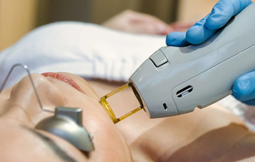 Tại sao ngày càng có nhiều khách hàng chọn Laser Alexandrite để thực hiện triệt lông?