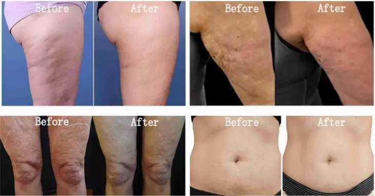 M8 Microneedle Rf Machine